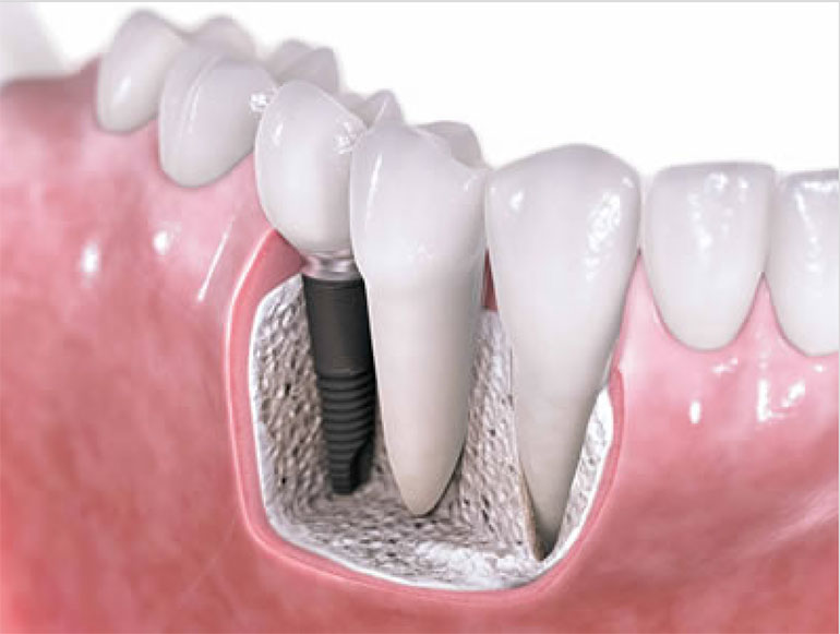 Illustration showing dental implant placement inside jawbone to replace missing tooth