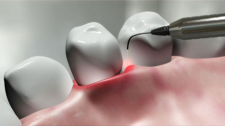 laser-dentistry-periodontal-care-gum-disease-therapy-770x433