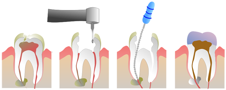 root-canal-therapy-endodontic-treatment-770x308